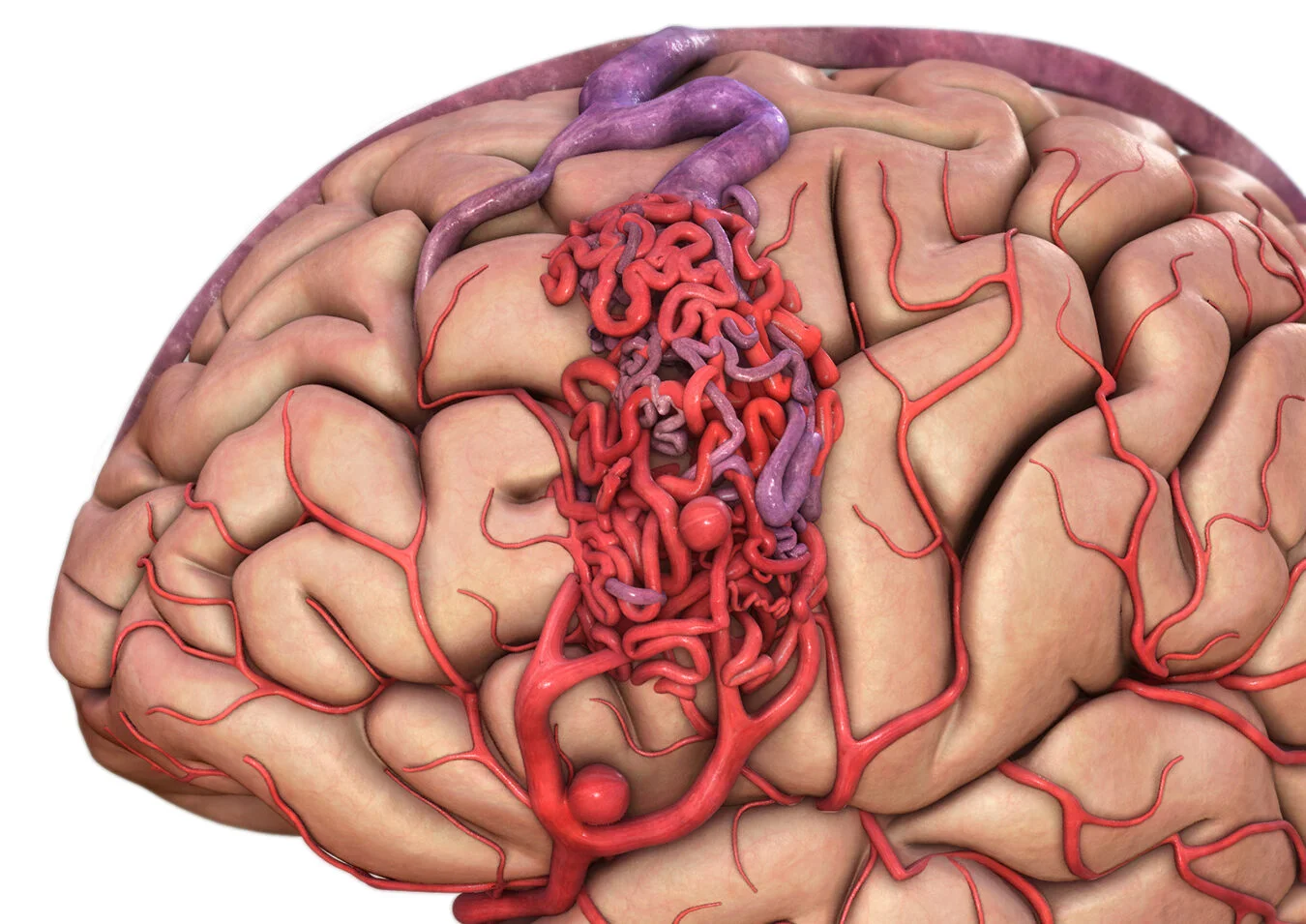 Απεικόνιση αγγειακών δομών εγκεφάλου