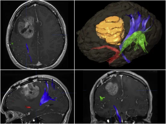 Προηγμένη Νευροχειρουργική Τεχνολογία στο χειρουργείο