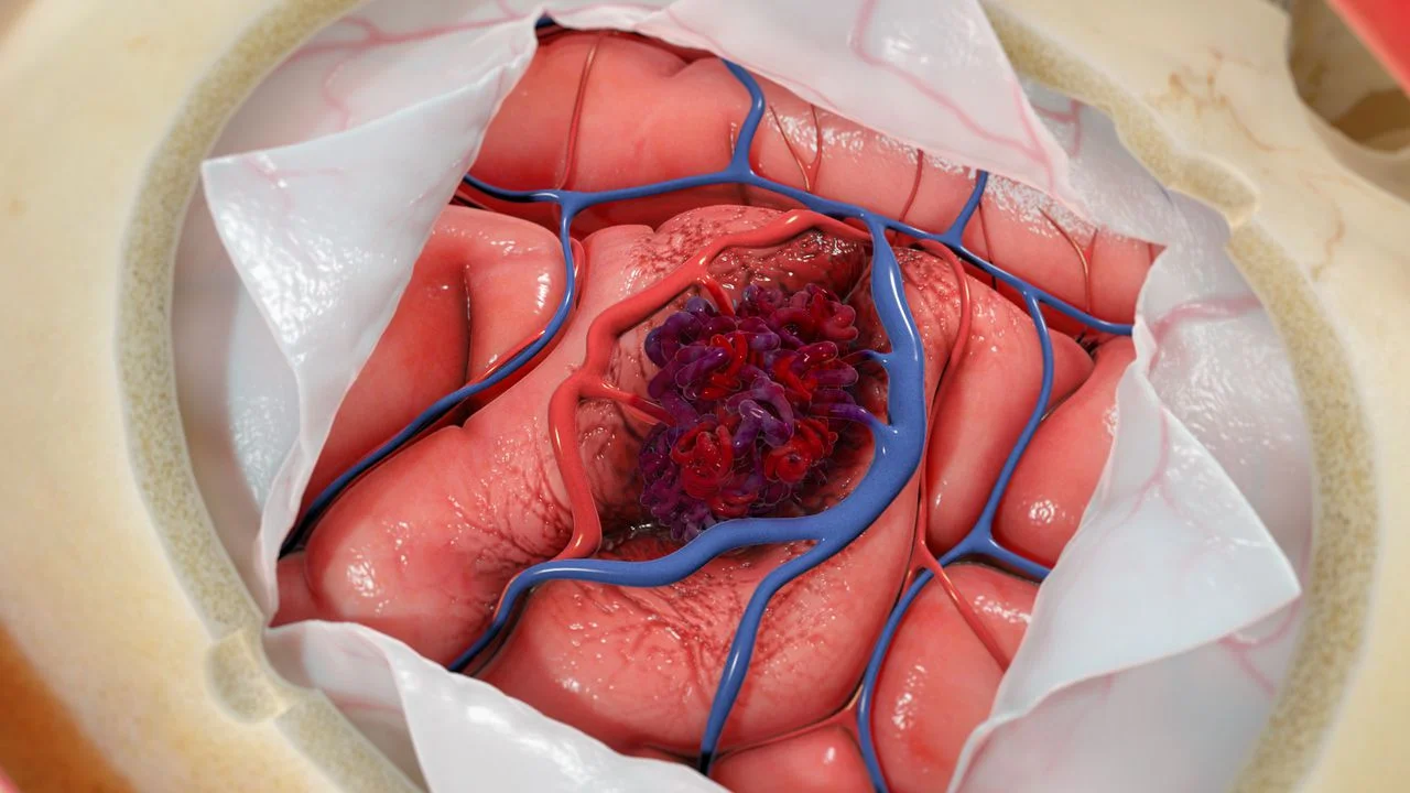 Υβριδική αίθουσα AVM