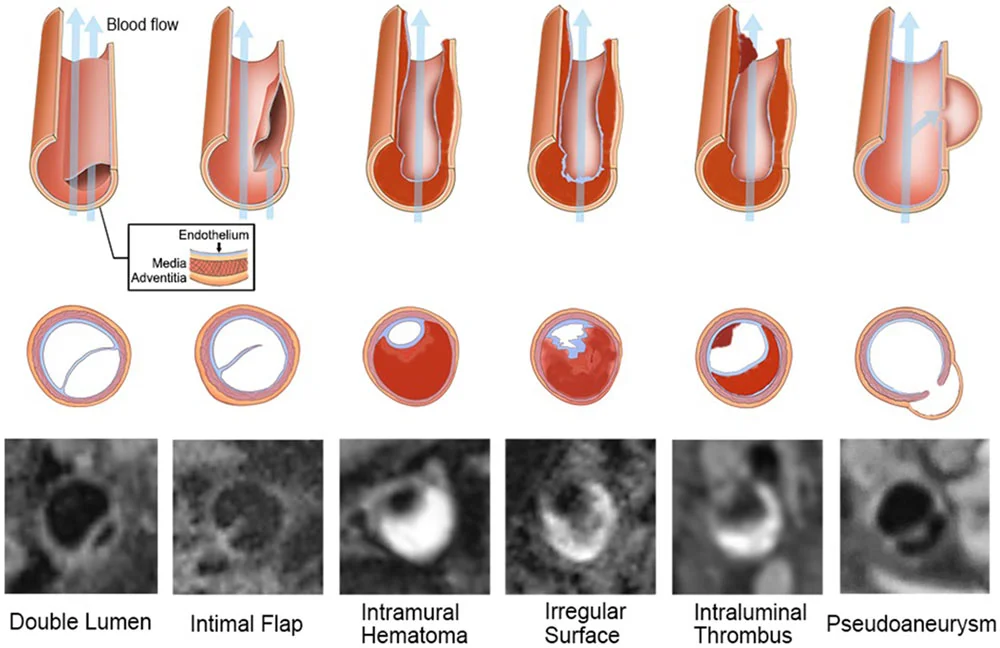 Απεικόνιση ενδοκράνιας διατομής με ψευδοανεύρυσμα