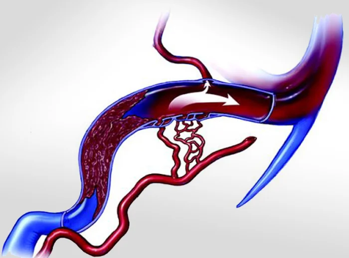 Αγγειογραφία σκληρομηνιγγικού συριγγίου