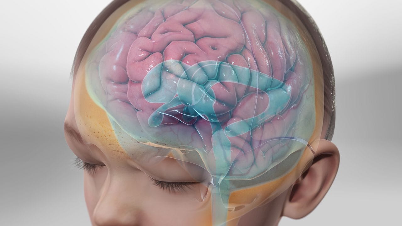 Απεικόνιση κοιλιών εγκεφάλου σε υδροκεφαλία ενηλίκων