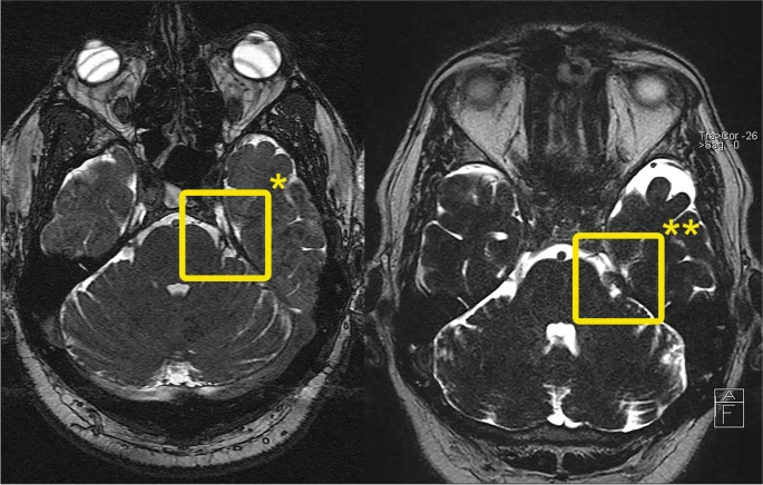 Νευραλγία & Χρόνιος Πόνος
