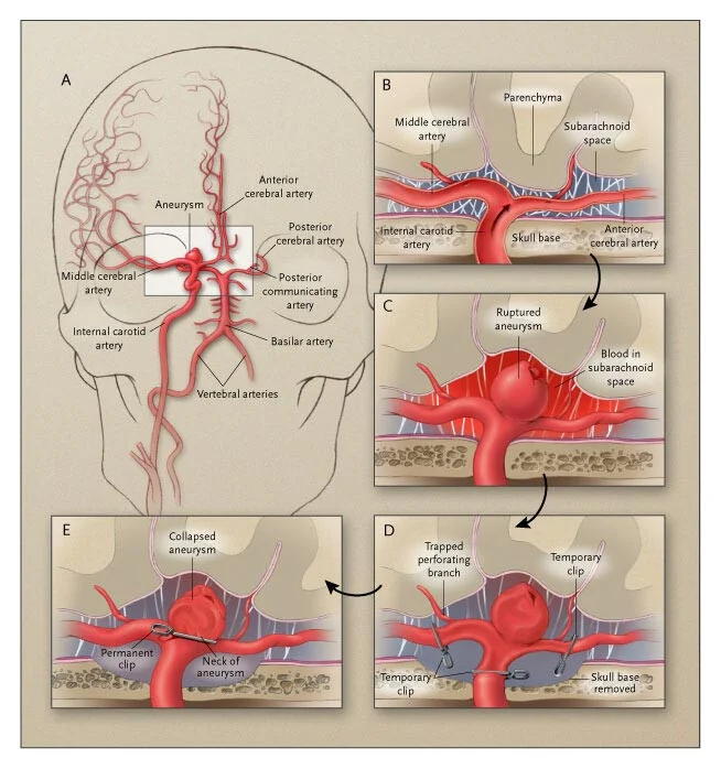 Σχηματική απεικόνιση ανευρύσματος & SAH