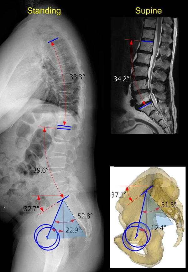 Προεγχειρητικός σχεδιασμός παραμόρφωσης με full-length ακτινογραφίες και μετρήσεις ισορροπίας