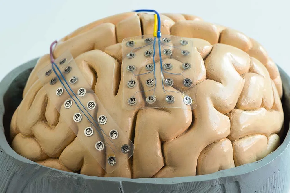 Κρανιοτομία σε Εγρήγορση – λειτουργική χαρτογράφηση και ασφαλής αφαίρεση βλάβης