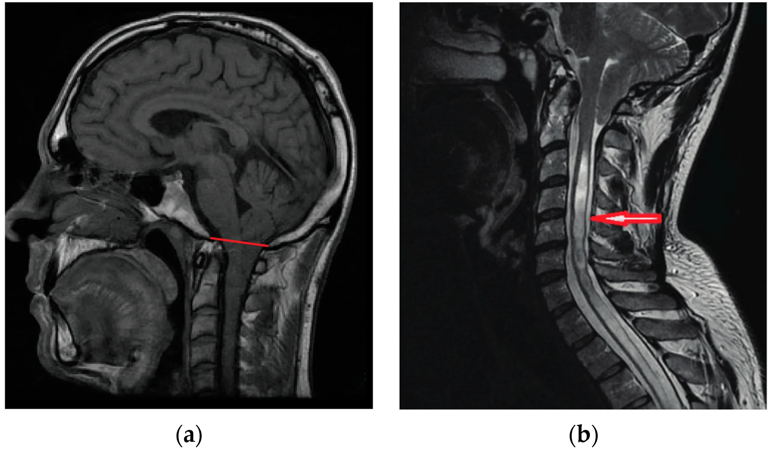Μαγνητική τομογραφία παιδιού με δυσπλασία Chiari και συριγγομυελία