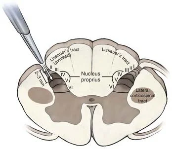 Απεικόνιση των οδών πόνου στον νωτιαίο μυελό και τον εγκέφαλο