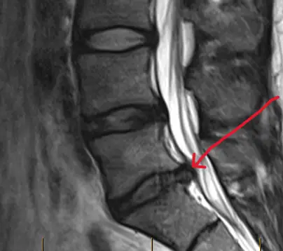 Μαγνητική τομογραφία με κήλη μεσοσπονδυλίου δίσκου και πίεση νευρικής ρίζας