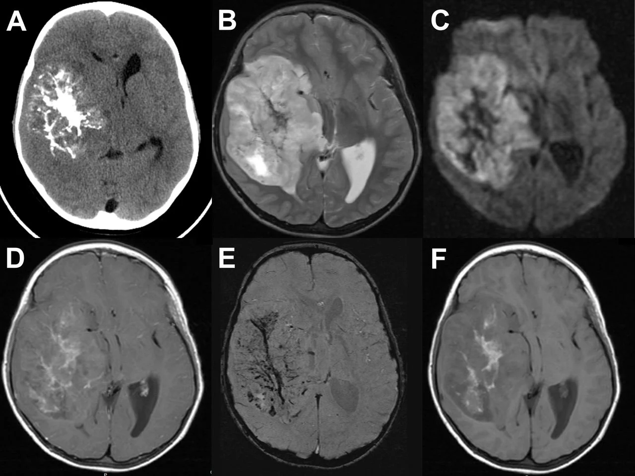 Μαγνητική τομογραφία παιδικού γλοιώματος εγκεφάλου