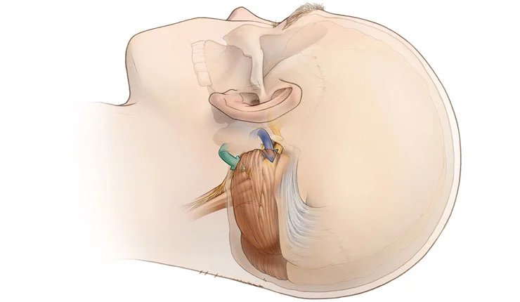 Μικροαγγειακή αποσυμπίεση (MVD) – απομάκρυνση αγγείου από κρανιακό νεύρο