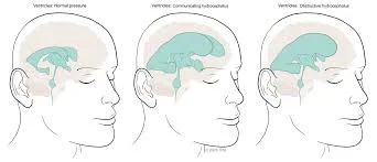 Μαγνητική τομογραφία εγκεφάλου με υδροκεφαλία φυσιολογικής πίεσης και βαλβίδα παροχέτευσης ΕΝΥ