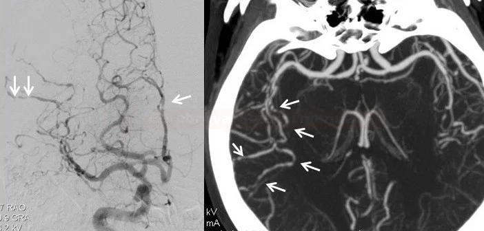 Aγγειογραφία εγκεφάλου με πολλαπλές εστιακές στενώσεις μέσου μεγέθους αρτηριών σε πρωτοπάθη αγγειίτιδα του κεντρικού νευρικού συστήματος