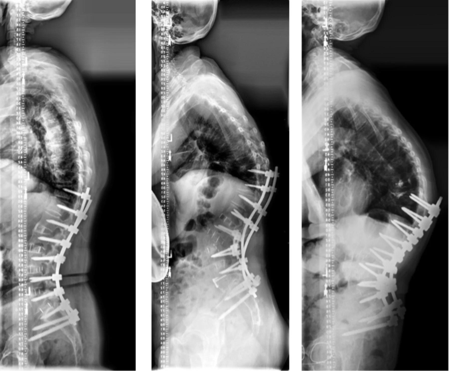 Απεικόνιση εγγύς γειτονικής κύφωσης πάνω από σπονδυλοδεσία