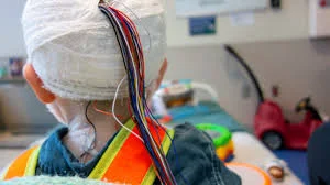 Χειρουργική επιληψίας σε παιδί – απεικόνιση εγκεφάλου