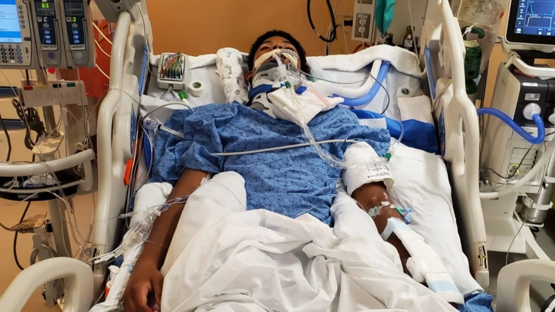 Ασθενής με κάκωση νωτιαίου μυελού σε μονάδα εντατικής θεραπείας