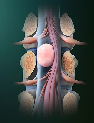 Εκτομή ενδοσκληρίδιου όγκου σπονδυλικής στήλης – μικροχειρουργική αφαίρεση όγκου
