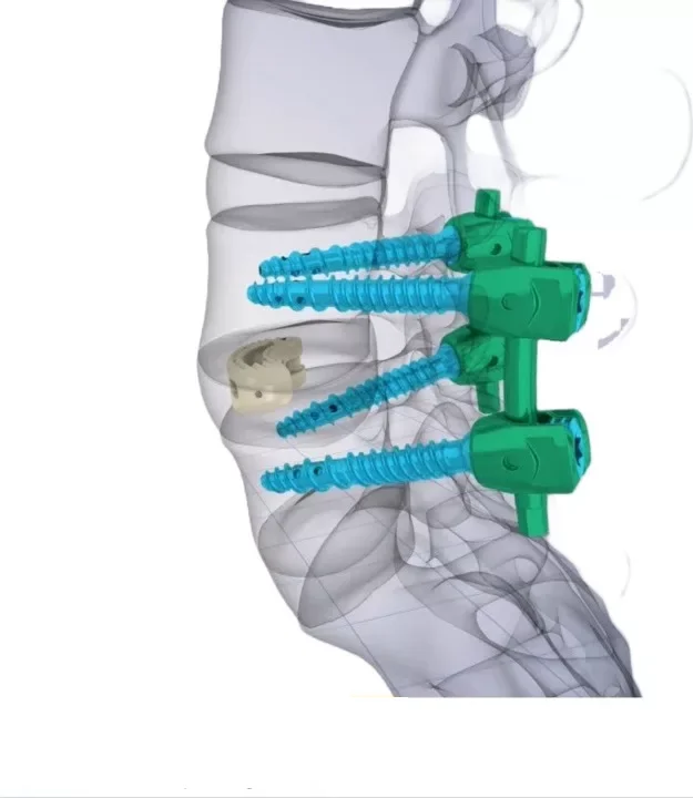TLIF – διατρηματική οσφυϊκή διασωματική σπονδυλοδεσία για σταθεροποίηση και αποσυμπίεση