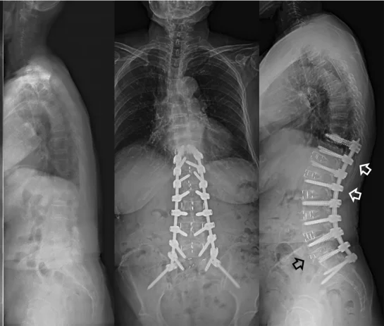 Χειρουργική σκολίωσης ενηλίκων – διόρθωση παραμόρφωσης σπονδυλικής στήλης