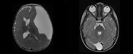 Μαγνητική τομογραφία παιδιού με αραχνοειδή κύστη