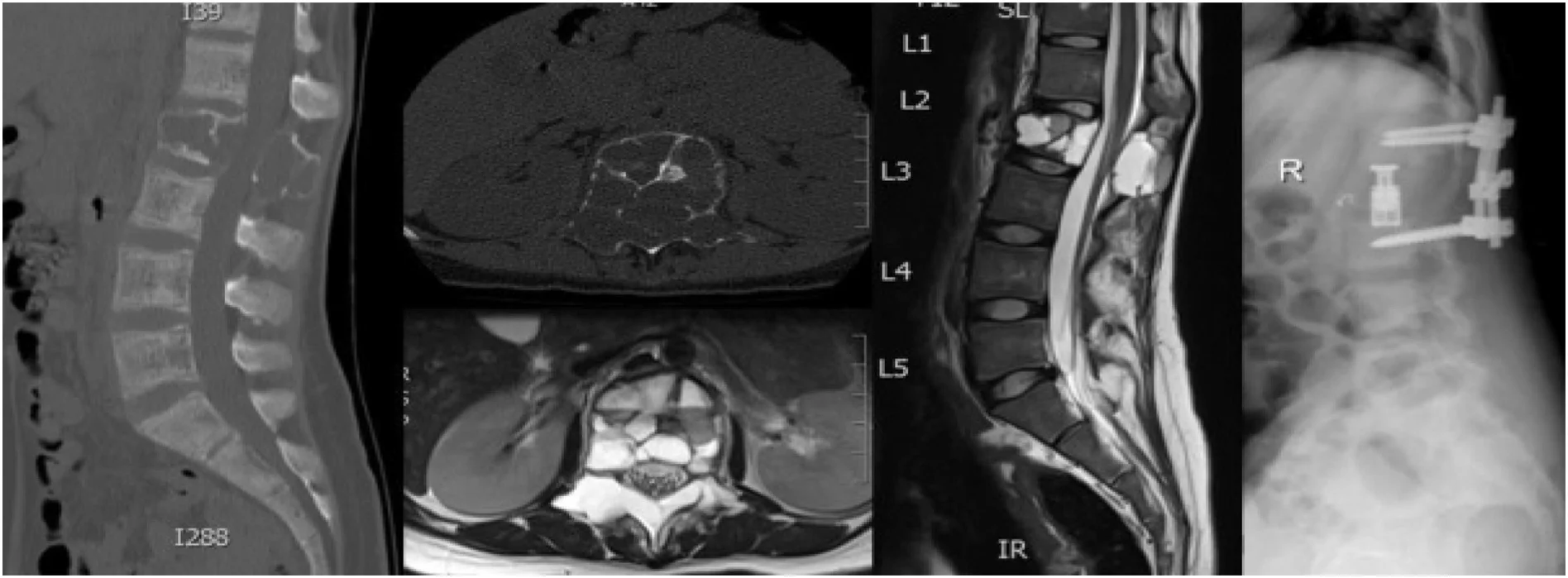 Απεικονιστική αξιολόγηση πρωτοπαθών όγκων σπονδύλων με MRI και CT