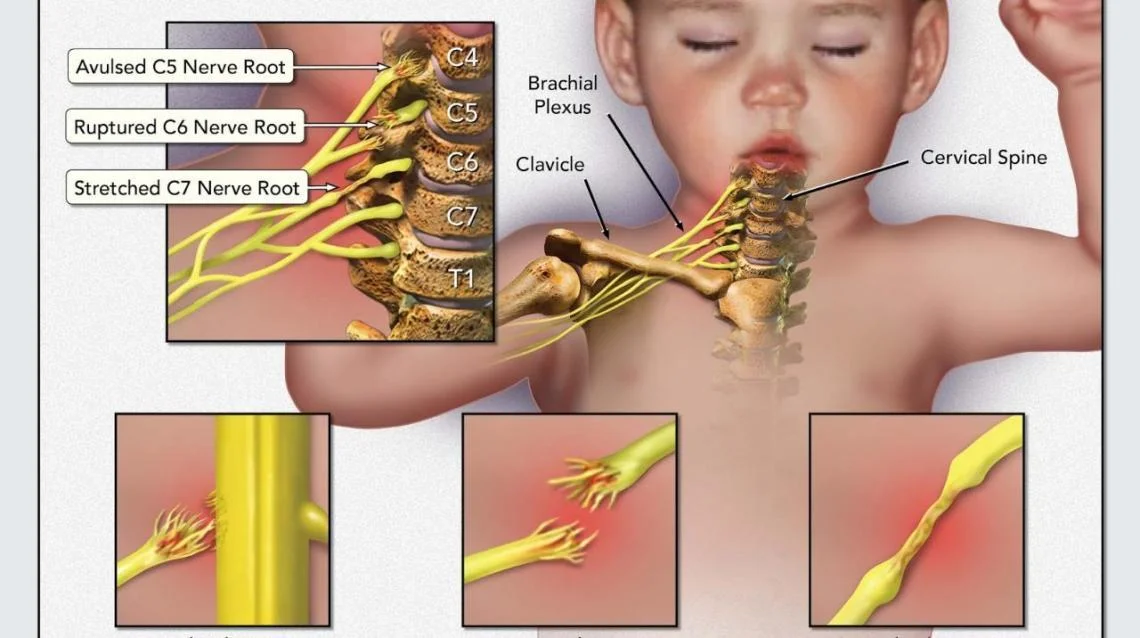 Βρέφος με μαιευτική βλάβη βραχιονίου πλέγματος σε πρόγραμμα φυσικοθεραπείας