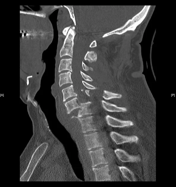 Απεικόνιση κάκωσης αυχενικής μοίρας σπονδυλικής στήλης με σταθεροποίηση