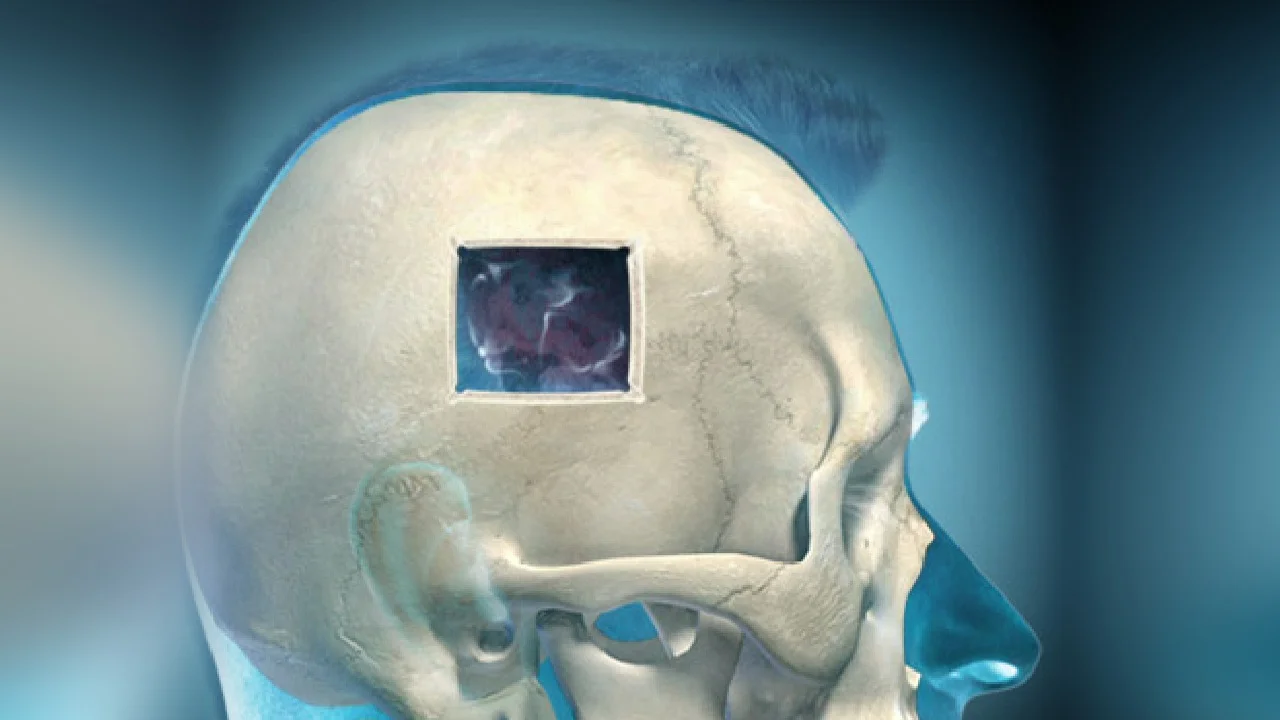 Κρανιοτομία – χειρουργική πρόσβαση στον εγκέφαλο