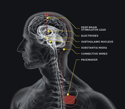 Deep brain stimulation για νόσο Parkinson σε εξειδικευμένο κέντρο