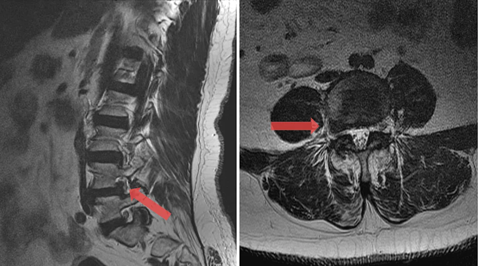 Απεικόνιση πλάγιας (far lateral) κήλης μεσοσπονδυλίου δίσκου που πιέζει την εξερχόμενη νευρική ρίζα
