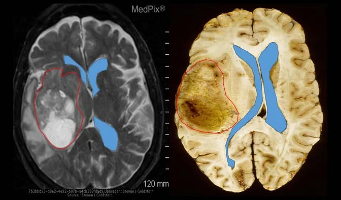Ενδεικτική απεικόνιση γλοιώματος υψηλής κακοήθειας (αντικαταστήστε με δική σας εικόνα)