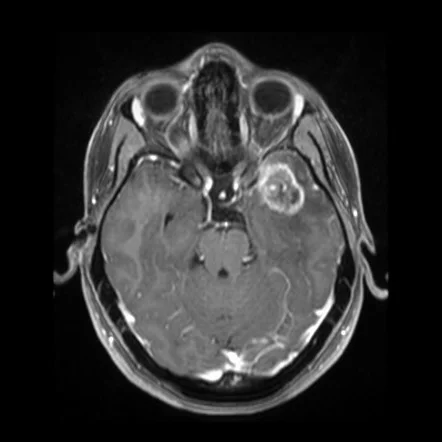 Ενδεικτική απεικόνιση γλοιονευρωνικού όγκου
