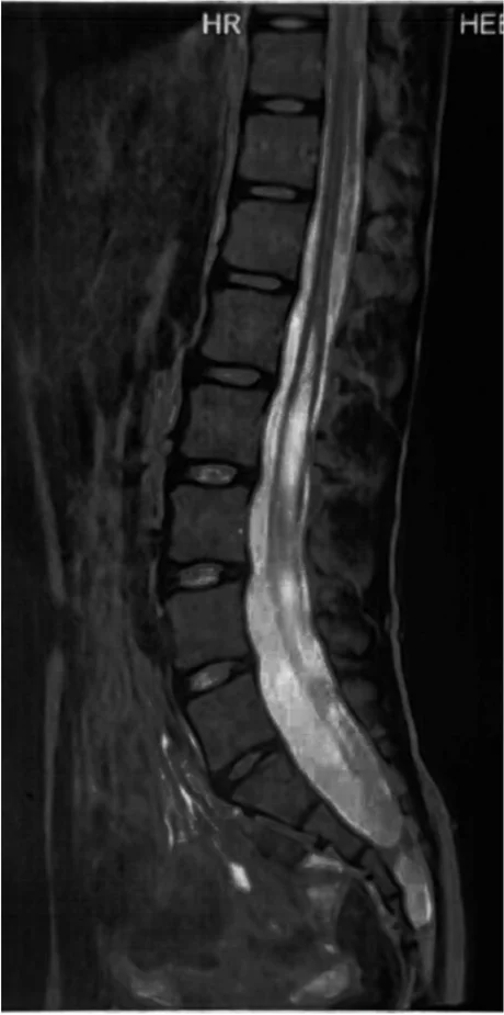 Απεικόνιση συριγγομυελίας και δεμένου νωτιαίου μυελού σε MRI