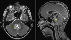 Μαγνητική τομογραφία παιδιού με όγκο οπισθίου βόθρου
