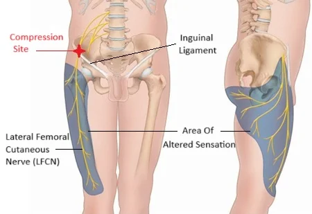 Ανατομική απεικόνιση του έξω μηροδερματικού νεύρου (LFCN) κοντά στον βουβωνικό σύνδεσμο