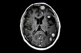 Ενδεικτική απεικόνιση εγκεφαλικών μεταστάσεων