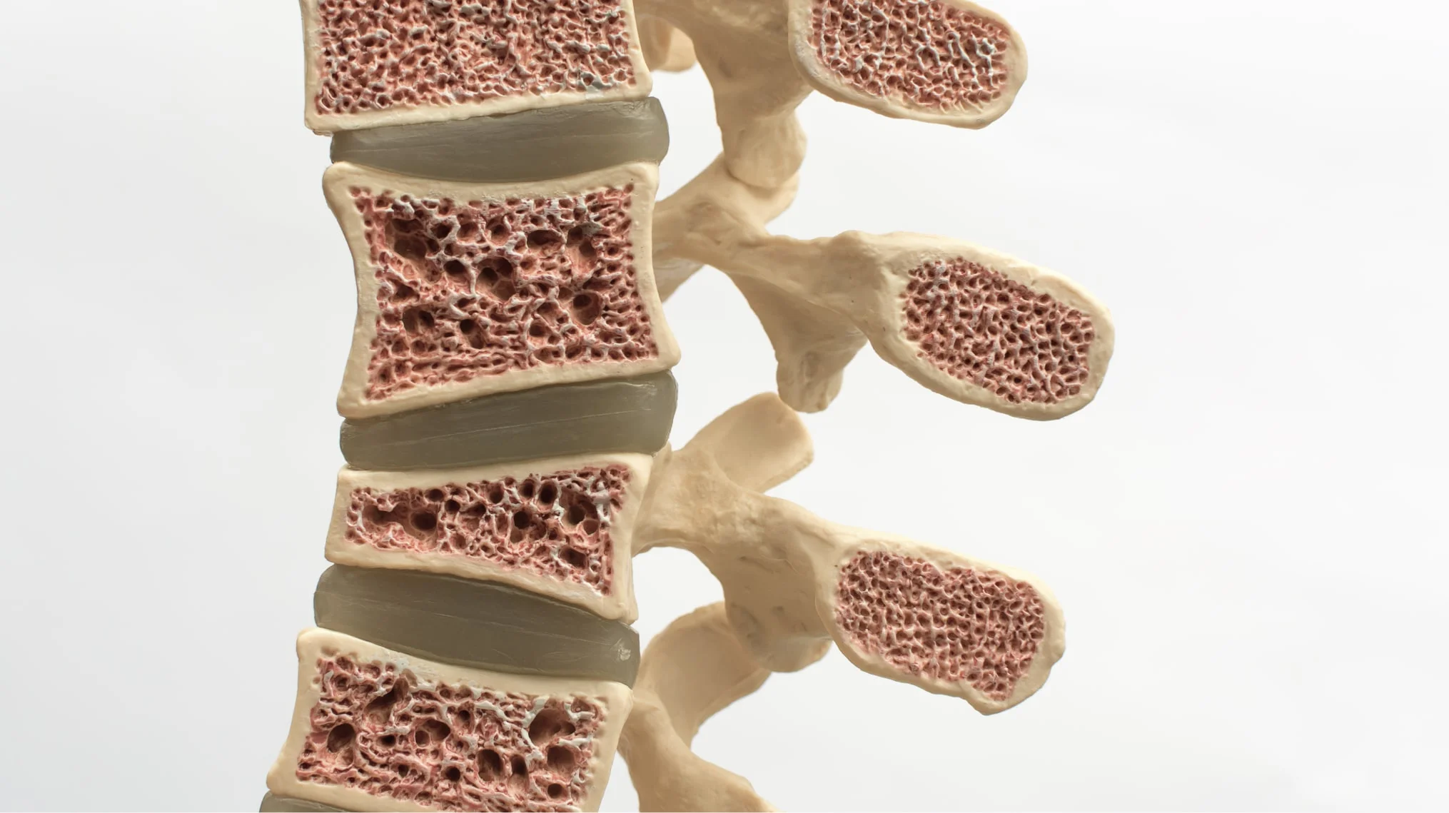 Απεικόνιση σπονδυλικών συμπιεστικών καταγμάτων λόγω οστεοπόρωσης