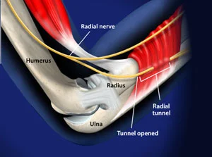 Σχηματική απεικόνιση της περιοχής του radial tunnel και της πορείας του οπισθίου μεσόστεου νεύρου (PIN)