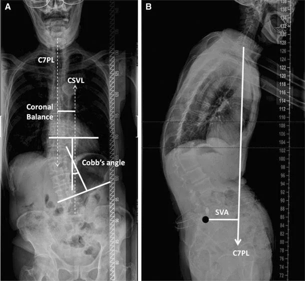 Ακτινογραφία ενηλίκου με σκολίωση και διαταραχή σπονδυλοπυελικής ισορροπίας