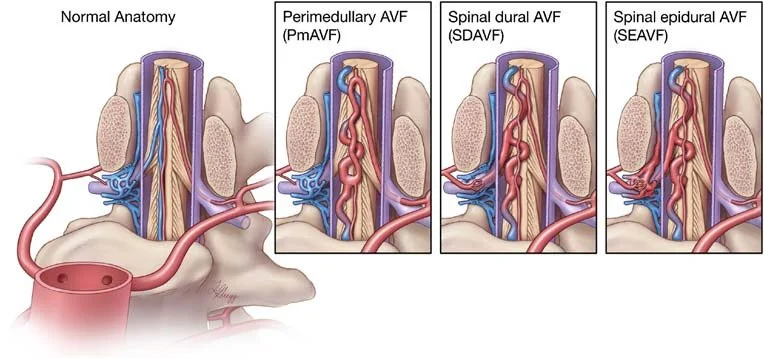 Αγγειογραφική εικόνα αρτηριοφλεβικού συριγγίου νωτιαίου μυελού