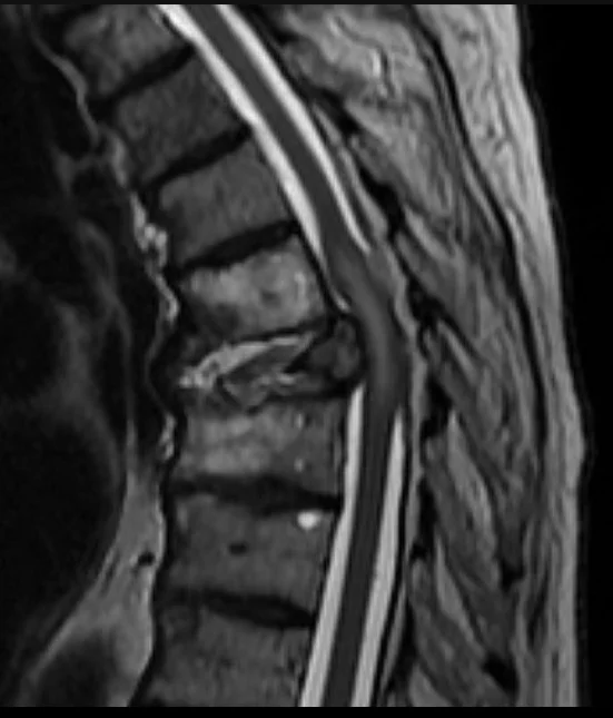 MRI σπονδυλικής στήλης με επισκληρίδια μεταστατική συμπίεση νωτιαίου μυελού
