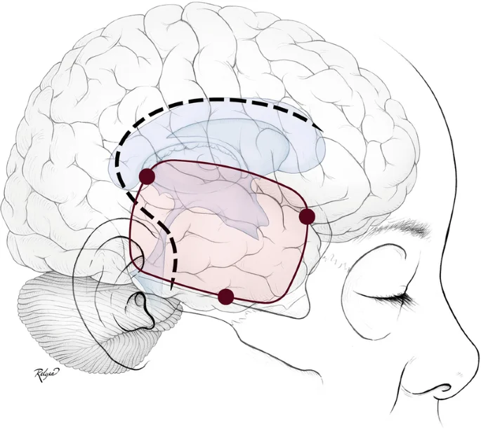 Κροταφική λοβεκτομή – χειρουργική θεραπεία εστιακής επιληψίας