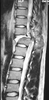 Απεικόνιση κατάγματος θωρακοσφυικής μοίρας με κάκωση νωτιαίου μυελού