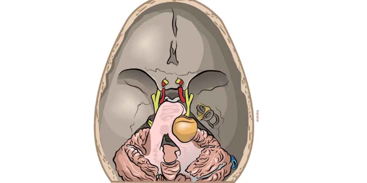 Χειρουργική αφαίρεση ακουστικού νευρινώματος (vestibular schwannoma)