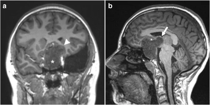 Ενδεικτική απεικόνιση κρανιοφαρυγγιώματος)