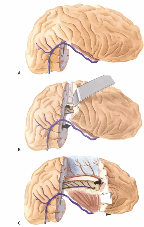 Λειτουργική ημισφαιρεκτομή – χειρουργική αποσύνδεση ημισφαιρίου για ανθεκτική επιληψία