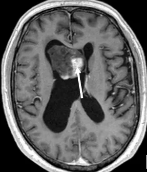 Ενδεικτική απεικόνιση ενδοκοιλιακής βλάβης