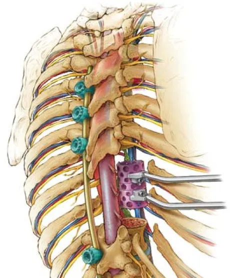 Θωρακική Σπονδυλεκτομή – αποσυμπίεση νωτιαίου μυελού και σταθεροποίηση θωρακικής μοίρας